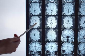 Calcio e ripetute commozioni cerebrali, neurologa: “Rischi a lungo termine”